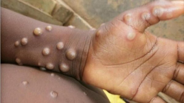 Urgent : Le Maroc détecte 3 cas suspects de variole du singe (ministère)