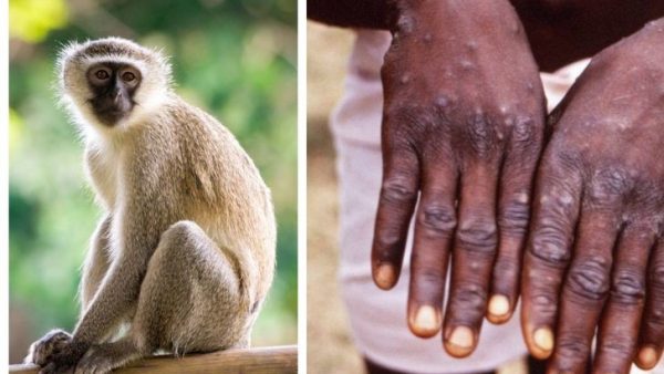 وزارة الصحة تكشف  النتائج المخبرية للحالات الثلاث المشتبه في إصابتها بفيروس جدري القردة