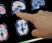 مرض دماغي غامض يثير رعــ..ـبا في كندا..  تسبب في وفاة 40 مواطنا