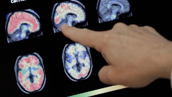 مرض دماغي غامض يثير رعــ..ـبا في كندا..  تسبب في وفاة 40 مواطنا