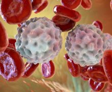 علاج تجريبي يظهر فعالية في شفاء مرضى سرطان الدم